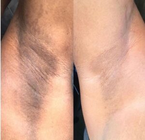 Waxing and Laser hair removal (6)